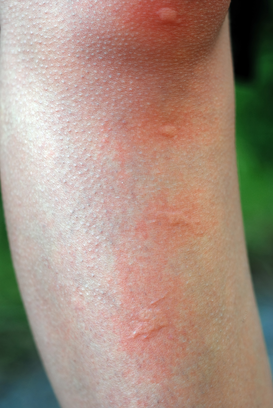What causes hives in adults?