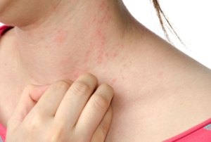 What are Hives and Swelling Episodes?