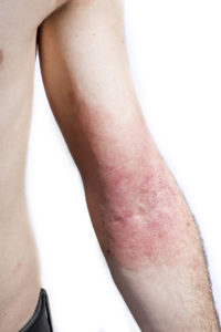 What is Eczema?