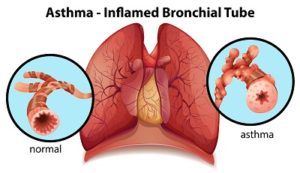 What is Asthma?