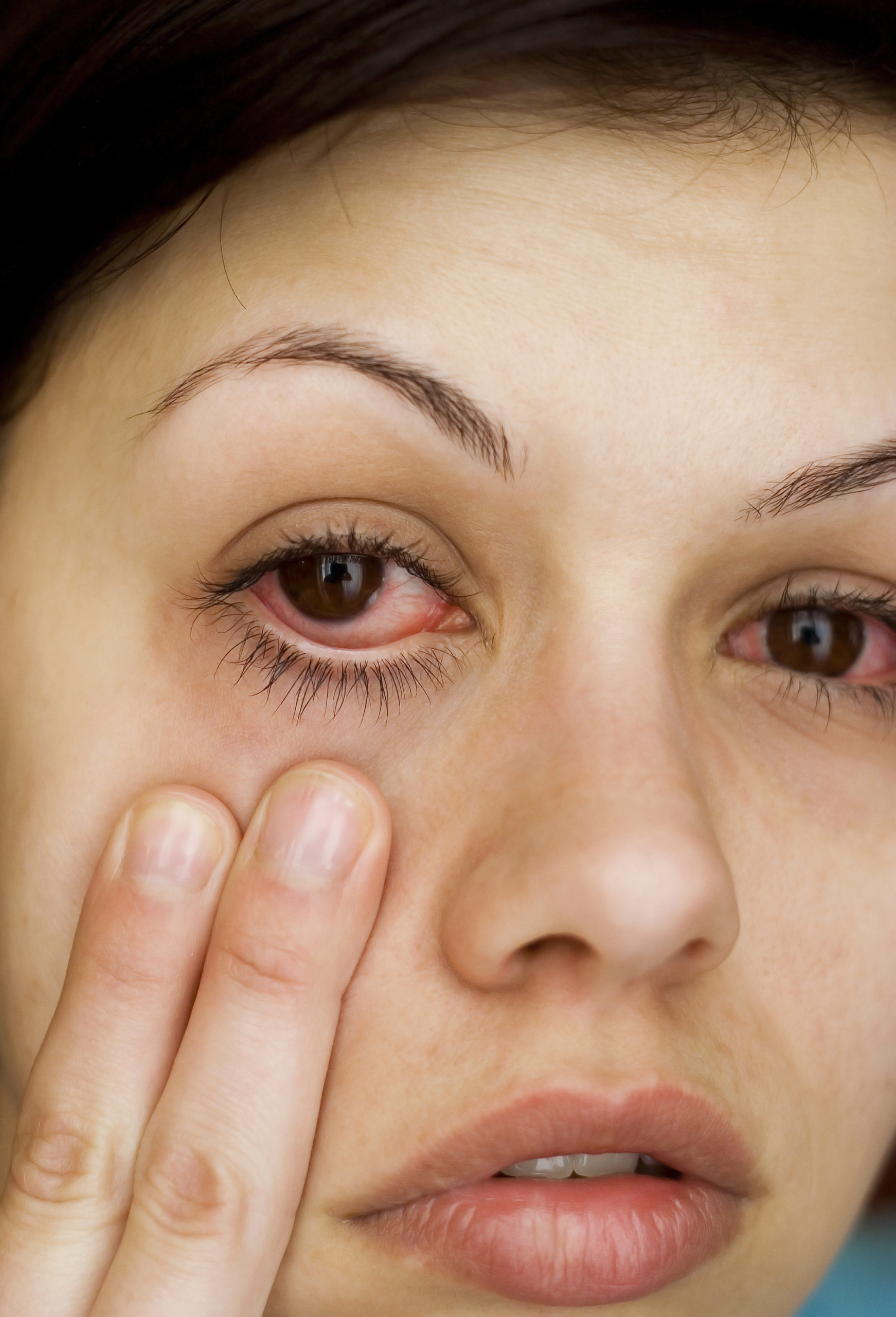 how to get rid of allergy black eyes