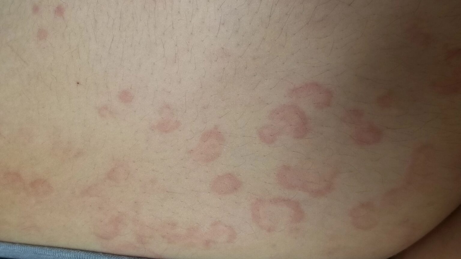 Em Rassh Erythema Multiforme - Black & Kletz Allergy