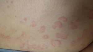 Erythema Multiforme