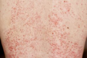 Toxic Epidermal Necrolysis