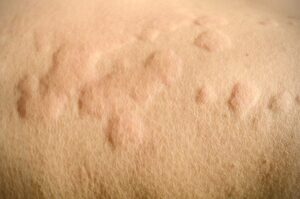Rhapsido – A New Treatment for Chronic Urticaria (Hives)